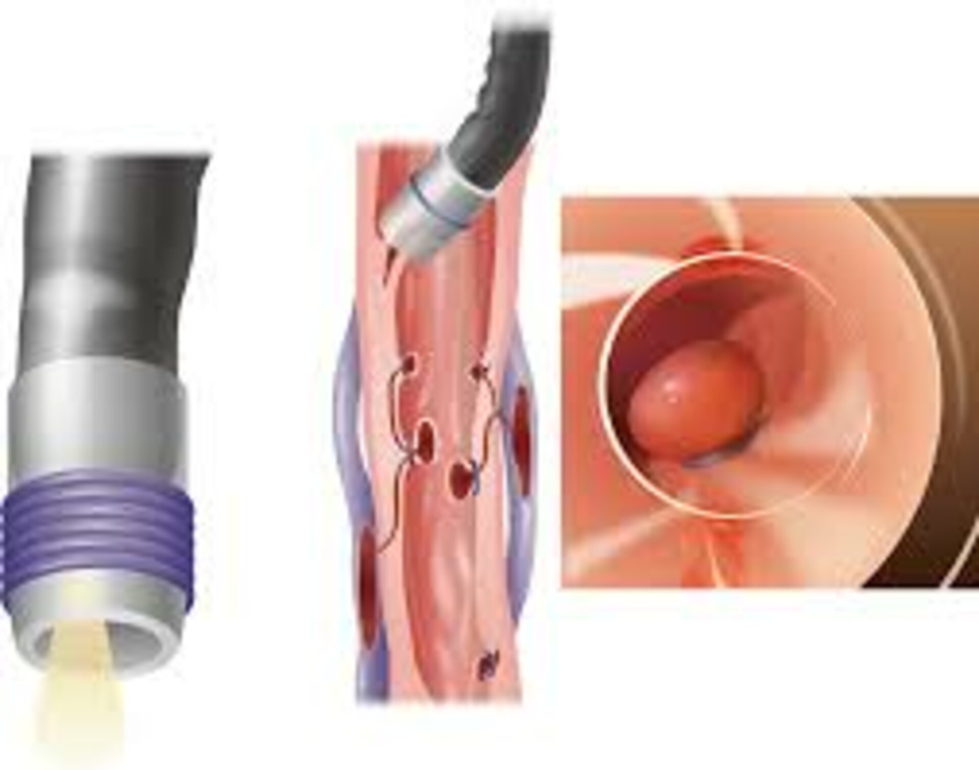 EVL (Endoscopic Variceal Band Ligation)