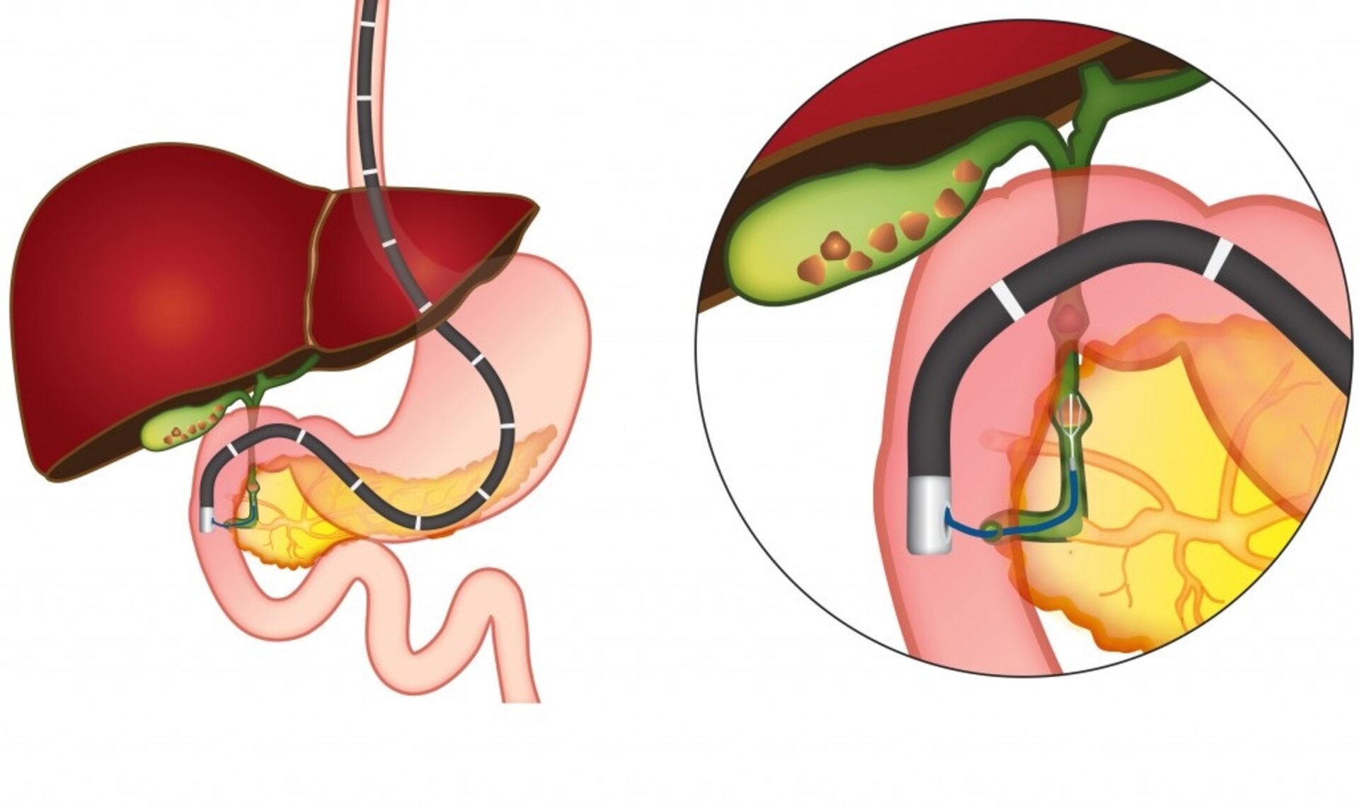 ERCP (Endoscopic Retrograde Cholangiography)